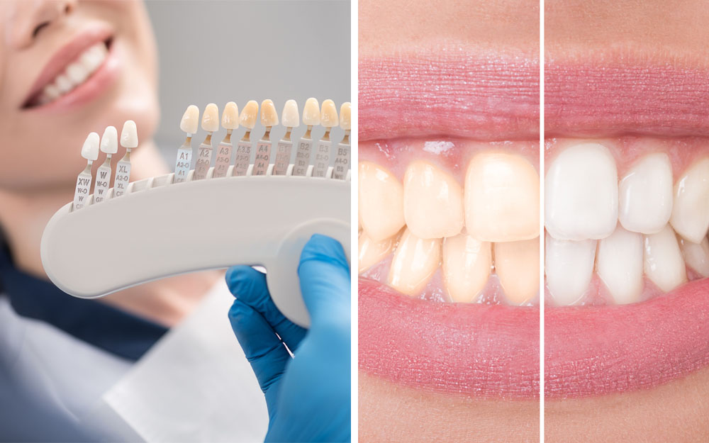 A Complete Overview of Minimally Invasive Bite Reclamation