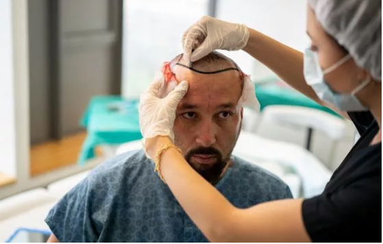 Interview with a Top Hair Transplant Surgeon